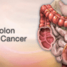 Colon Cancer on the Rise: A Warning Call for Young Adults